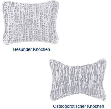 Vergleich eines gesunden Knochens mit einem Osteoporose Knochen